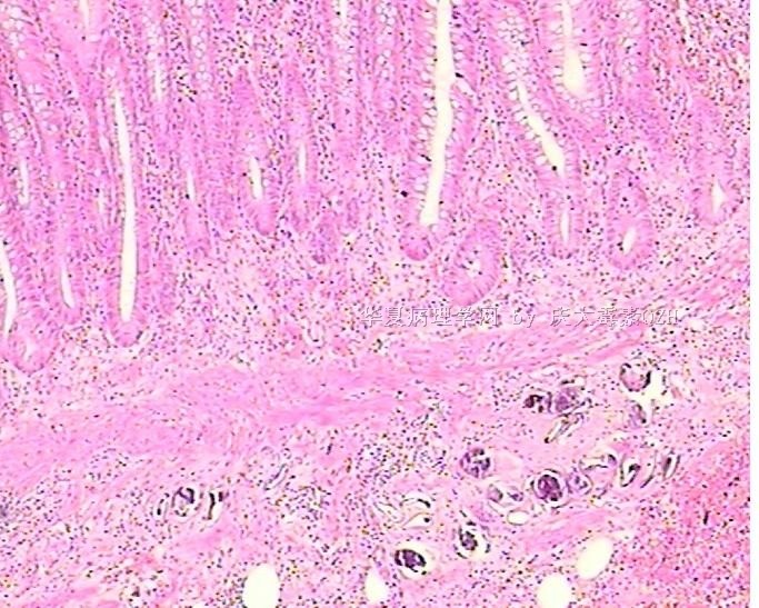 求助阑尾病理片图6