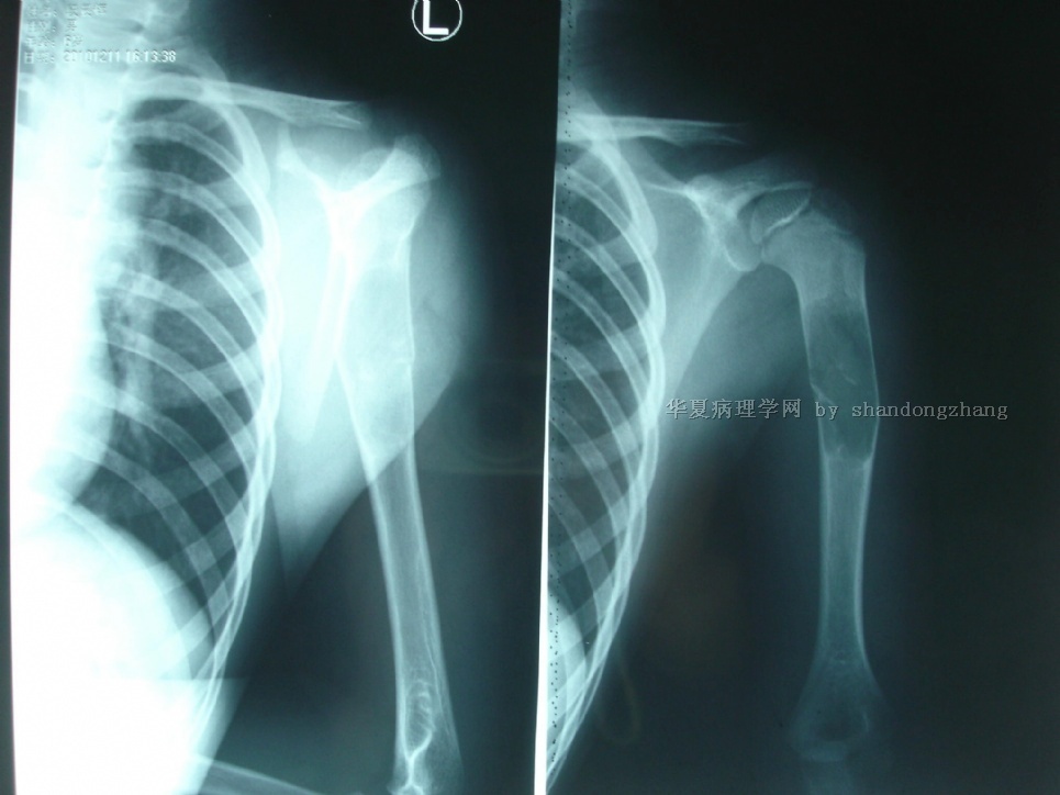 20101220-左肱骨中段骨囊肿图1