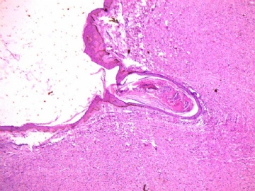 皮肤下块(神经纤维瘤)图1