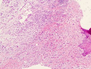 57 year old man with gluteal nodule图1