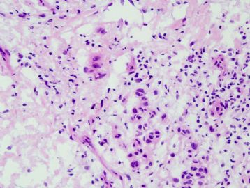 57 year old man with gluteal nodule图3