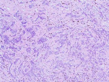 66 year woman with left atrial mass图1