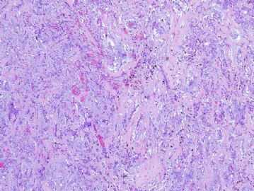 66 year woman with left atrial mass图2