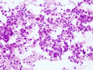 61 year old man with right lung nodule图1