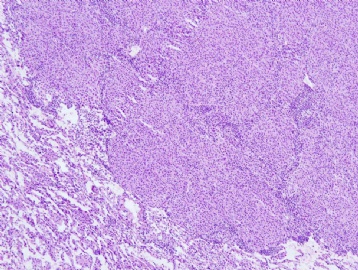 61 year old man with right lung nodule图2