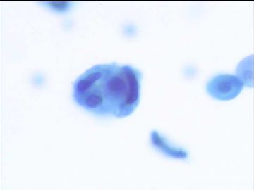 尿液液基细胞学病例图2