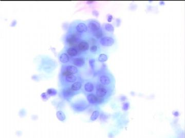 痰液基细胞学病例图4