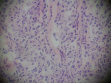 腮腺肿物，图3