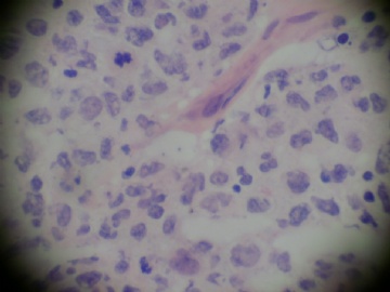 腮腺肿物，图8