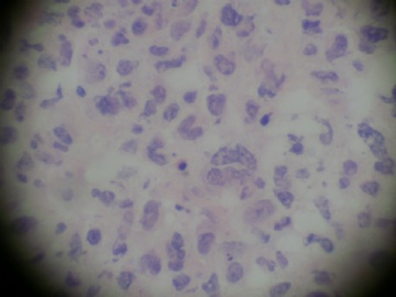 腮腺肿物，图9