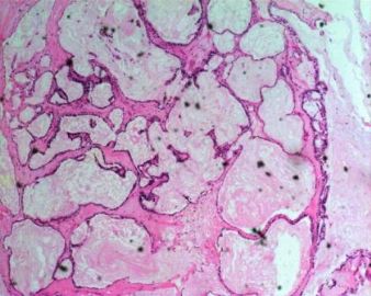 卵巢透明细胞癌（长的很经典的！）图1