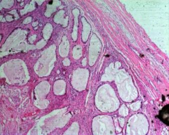 卵巢透明细胞癌（长的很经典的！）图4