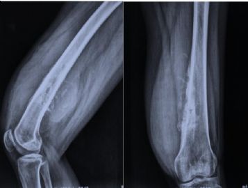春节首例：左大腿肿块（中-日-澳2009墨尔本病理读片会病例3）图1