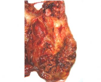 春节首例：左大腿肿块（中-日-澳2009墨尔本病理读片会病例3）图2