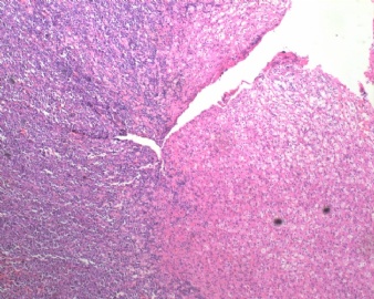 右肾上腺区肿块（2）图1