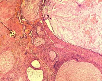 子宫内膜腺癌合并双侧卵巢肿瘤图1