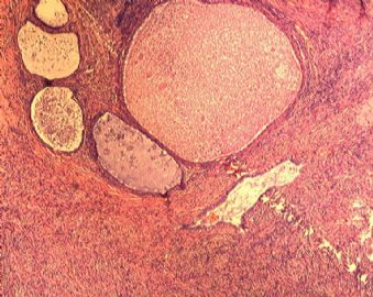 子宫内膜腺癌合并双侧卵巢肿瘤图2