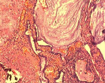子宫内膜腺癌合并双侧卵巢肿瘤图4
