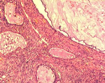 子宫内膜腺癌合并双侧卵巢肿瘤图5