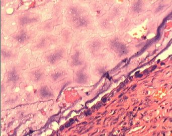 子宫内膜腺癌合并双侧卵巢肿瘤图6