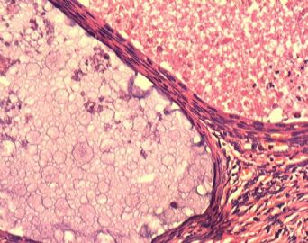 子宫内膜腺癌合并双侧卵巢肿瘤图7
