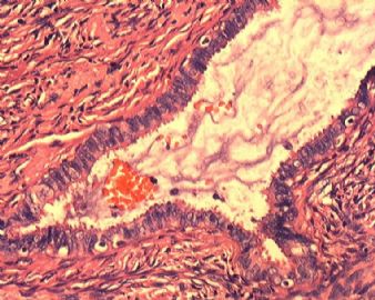 子宫内膜腺癌合并双侧卵巢肿瘤图8