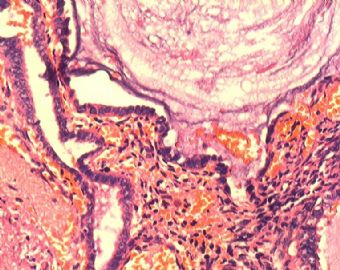 子宫内膜腺癌合并双侧卵巢肿瘤图9