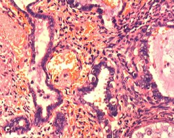 子宫内膜腺癌合并双侧卵巢肿瘤图10