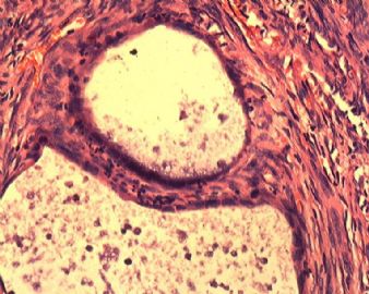 子宫内膜腺癌合并双侧卵巢肿瘤图11