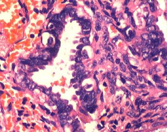 子宫内膜腺癌合并双侧卵巢肿瘤图13