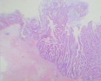 请欣赏---罕见的膀胱肿瘤形态图2