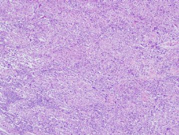 60 year old man with mediastinal mass图1