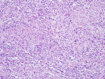 60 year old man with mediastinal mass图2