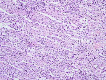 60 year old man with mediastinal mass图3