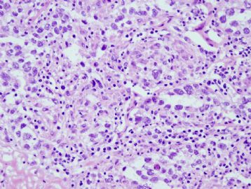 60 year old man with mediastinal mass图4