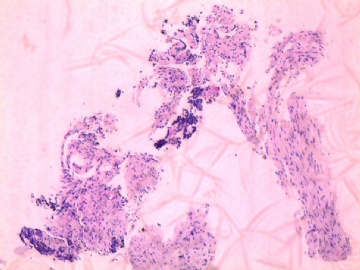 纤支镜活检图4