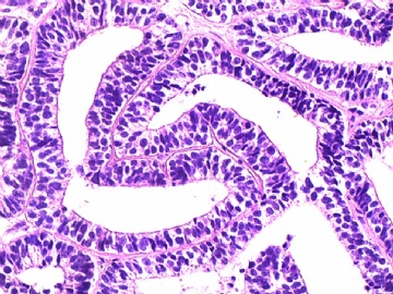右侧上、中肺间肿块，有蒂与纵膈相连(上皮型肺母细胞瘤）图3