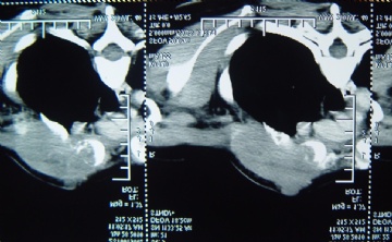 [已有最后诊断]右乳腺癌术后5年 右锁骨上肿块图1