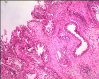 膀胱肿瘤（8）图7