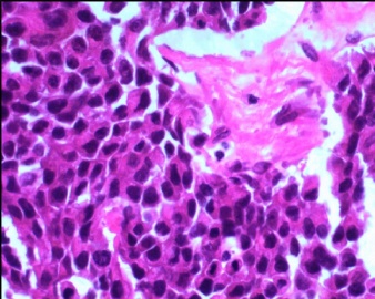 膀胱肿瘤（8）图9