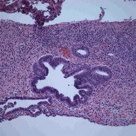 Endomyometrial biopsy.图3