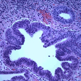 Endomyometrial biopsy.图4