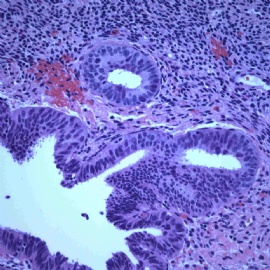 Endomyometrial biopsy.图5