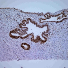 Endomyometrial biopsy.图6