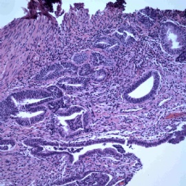 Endomyometrial biopsy.图7