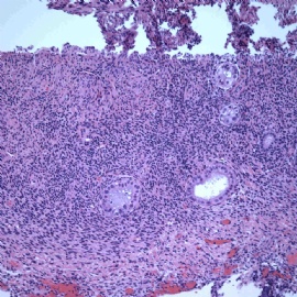 Endomyometrial biopsy.图9