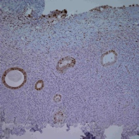 Endomyometrial biopsy.图10