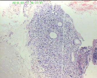 49岁男性上腹溃疡性质？图1