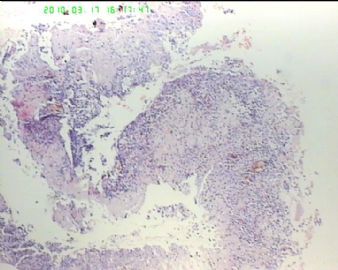 49岁男性上腹溃疡性质？图2