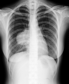 右侧上、中肺间肿块，有蒂与纵膈相连(上皮型肺母细胞瘤）图12